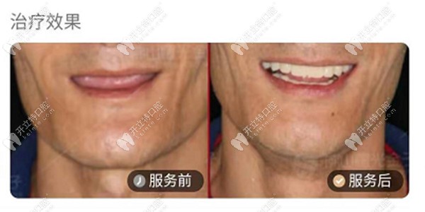 全口牙缺失種植前后圖片