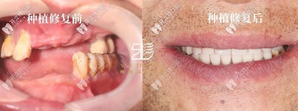 數(shù)字化種牙進(jìn)行中:采用諾貝爾allon6+4全口負(fù)重技術(shù)