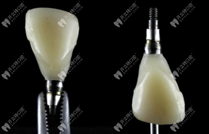 臨時牙冠的口外掃描