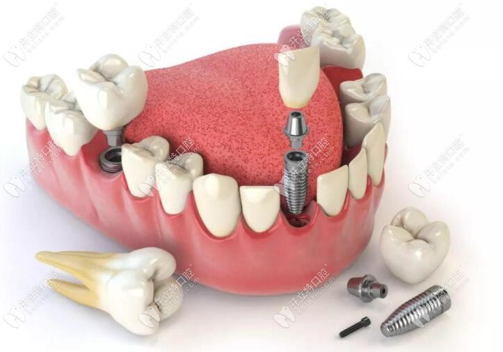 種植牙結(jié)構(gòu)