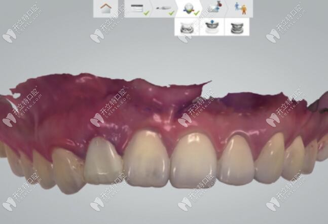 放入臨時牙冠使輪廓清晰