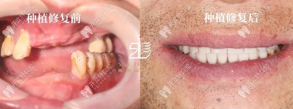 梁先生種植修復(fù)前后對(duì)比