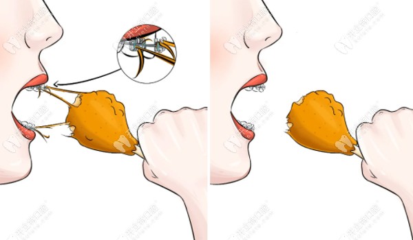 球面托槽清潔度高