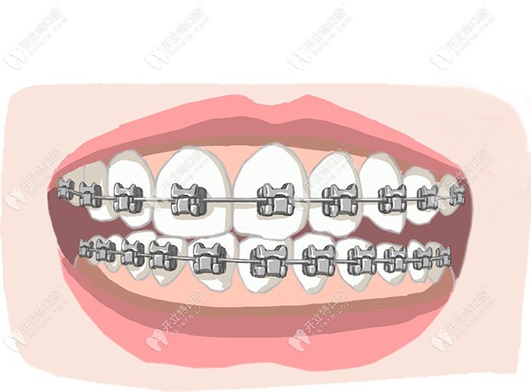 以色列科特斯種植牙的價格低到5100元起,就在福永河山口腔