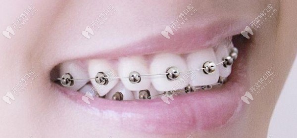 球面自鎖托槽牙套