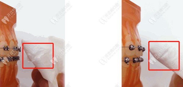 自鎖托槽中球面牙套好是方形牙套好，二者優(yōu)缺點先搞清哦