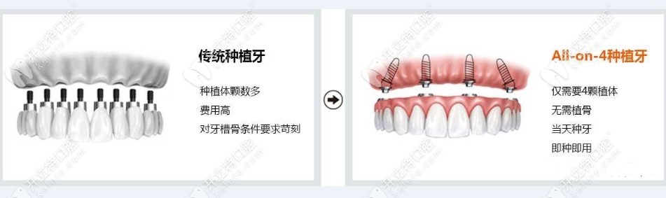 傳統(tǒng)種植牙和all on 4種植牙對比