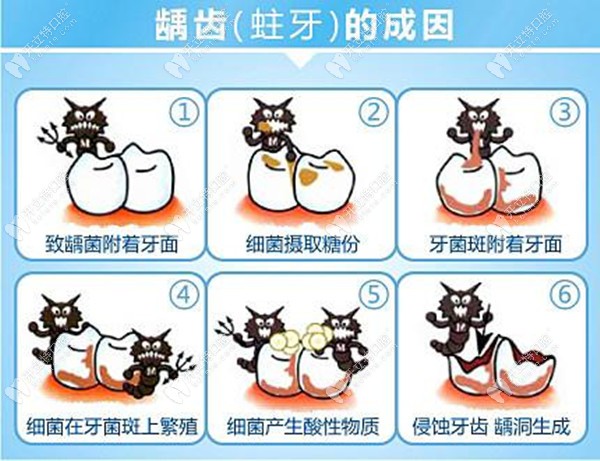 跪求廈門補(bǔ)牙哪家醫(yī)院好，補(bǔ)蛀牙一般多少錢一顆