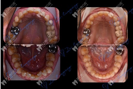 牙齒矯正前后對(duì)比