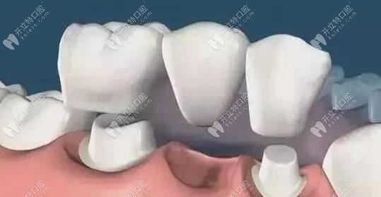 固定烤瓷牙橋