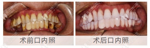 即刻種植牙手術(shù)前后對(duì)比