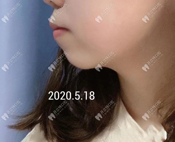 重慶華美口腔丁愛軍醫(yī)生矯正骨性齙牙嘴凸效果怎么樣？