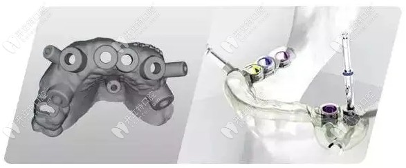 康貝佳數(shù)字化種植牙