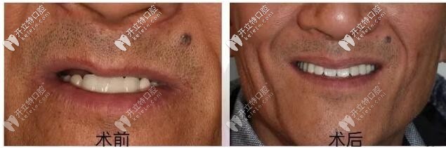 70歲大爺做allon4即刻半口種植牙修復詳解