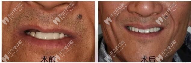 老人半口修復(fù)成功