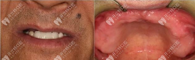 老人上頜無(wú)牙