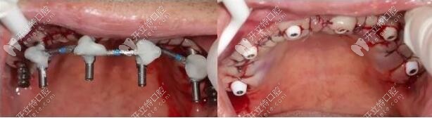 定位種植位點(diǎn)