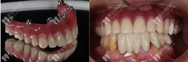 即刻修復(fù)體