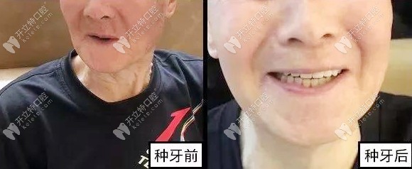 張叔叔種牙前后的效果圖 張叔叔種牙前后的效果圖