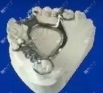 鑄造不銹鋼托假牙