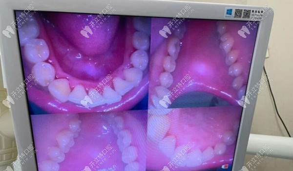 重慶團(tuán)圓口腔時(shí)代天使矯正