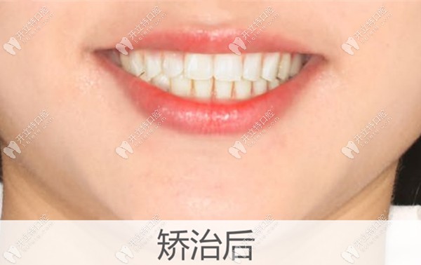 牙齒擁擠不齊矯正后的效果