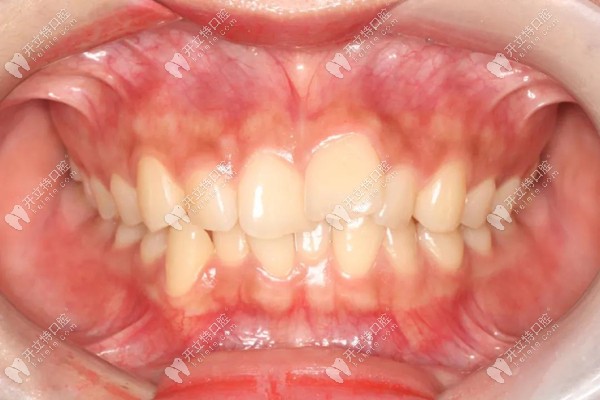 矯治前的口內(nèi)照