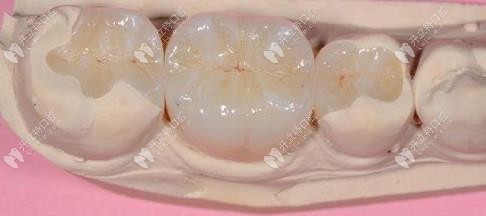 樹(shù)脂補(bǔ)牙外觀圖
