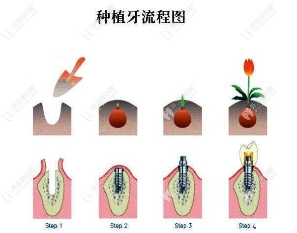 種植牙流程圖解 種植牙流程圖解