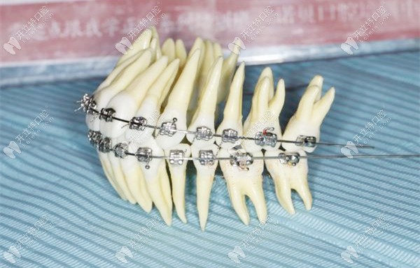 直絲弓傳動(dòng)矯正