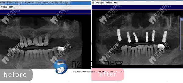 上半口做了6顆即刻負(fù)重種植牙的CT片