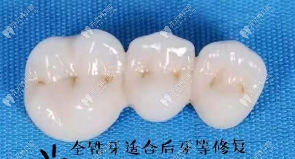 全鋯牙適合做后牙等修復