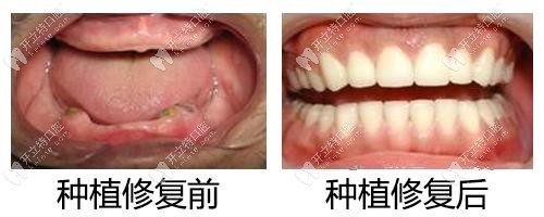 全口種植牙價(jià)格