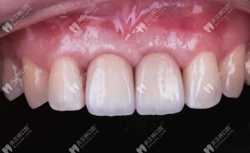 整個(gè)修復(fù)病例完成后的情況 整個(gè)修復(fù)病例完成后的情況