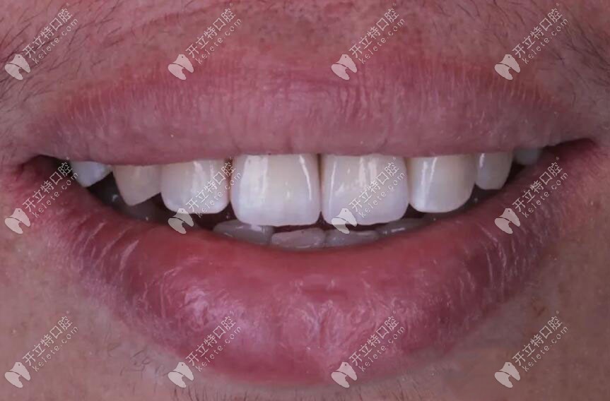 種植牙完成修復(fù)后的情況 種植牙完成修復(fù)后的情況