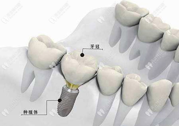 瑞士iti軟組織水平種植體與骨結(jié)合牙植體,哪個(gè)適合磨牙種植