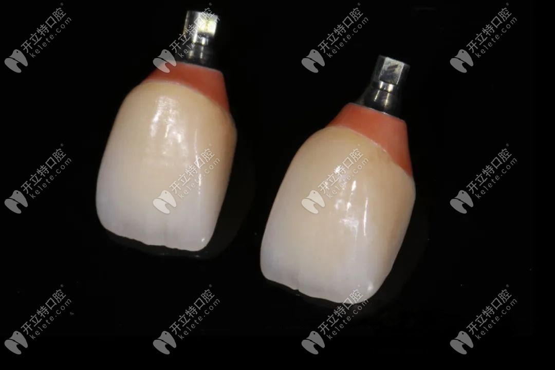 種植后長(zhǎng)久性牙冠的修復(fù) 種植后長(zhǎng)久性牙冠的修復(fù)